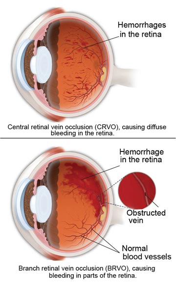 Retinal Vein Occlusion | South Bay Ophthalmology