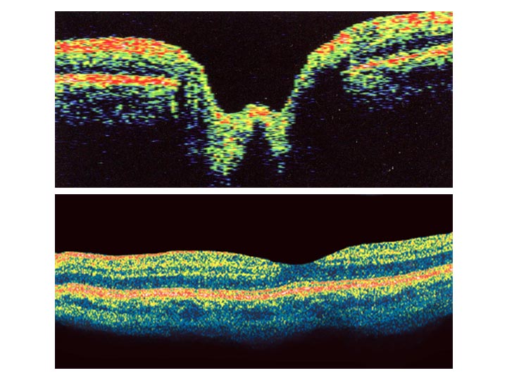 accuracy of retina scan